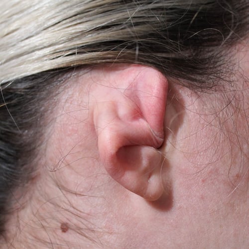 Microtia Awareness Day